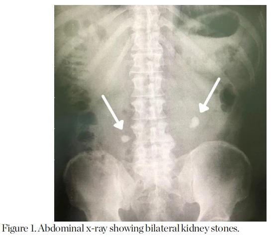Abdominal x-ray showing bilateral kidney stones.
